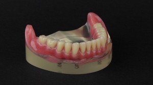 peek denture prosthesis 1