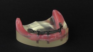 peek denture prosthesis 2