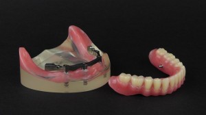 peek denture prosthesis 3