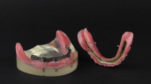 peek denture prosthesis 4