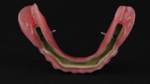 peek denture prosthesis 6