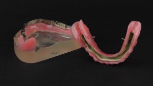 peek denture prosthesis 5